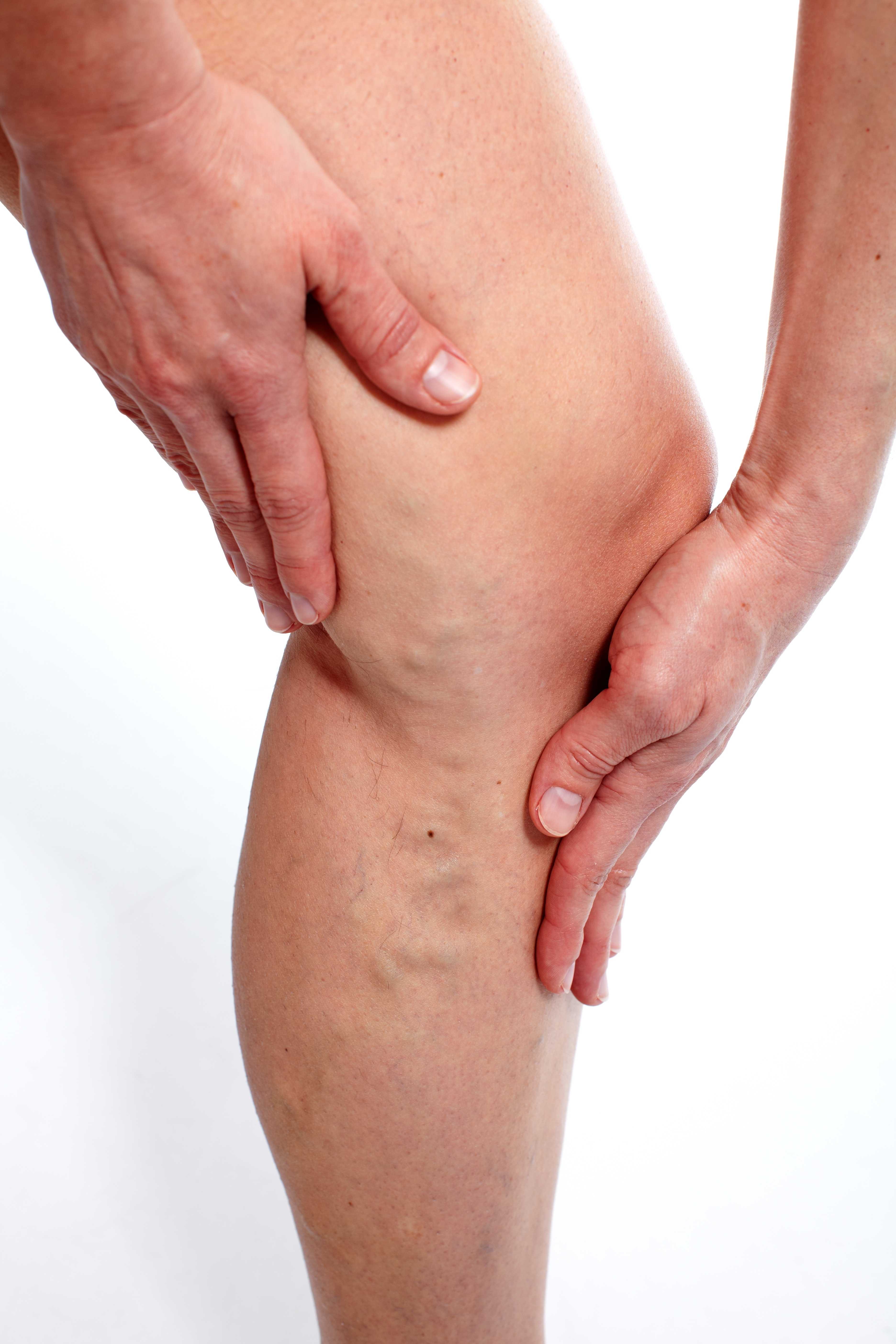 4 Strategies to Prevent Varicose Veins and Have Flawless Legs