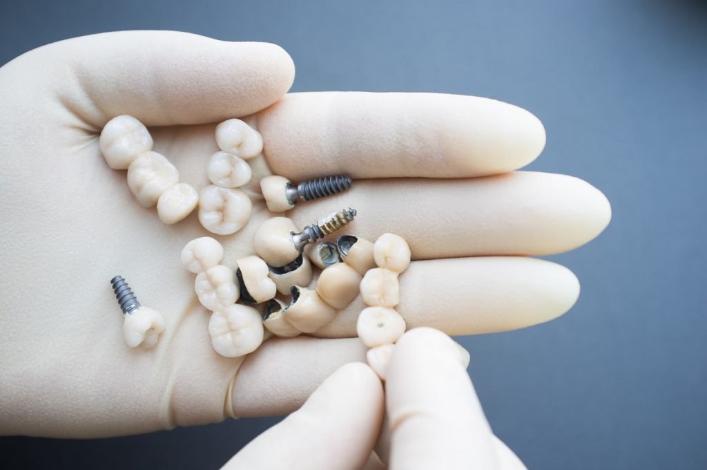 Dental implants on a hand