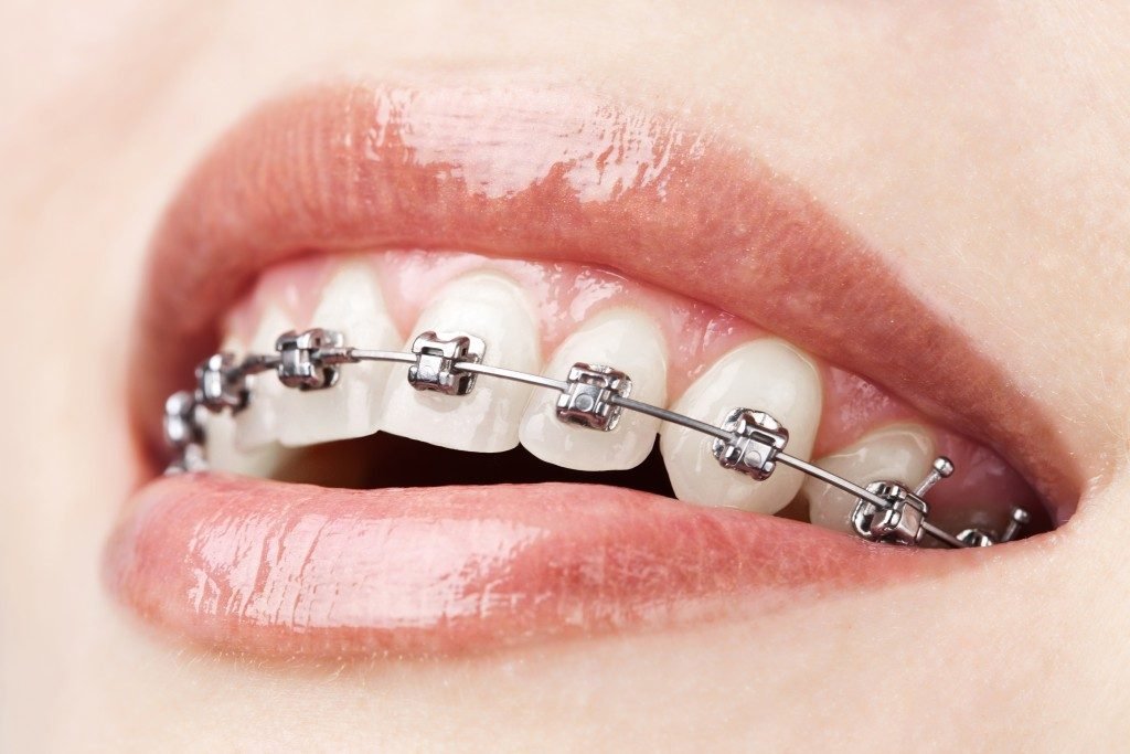 Woman's mouth with braces