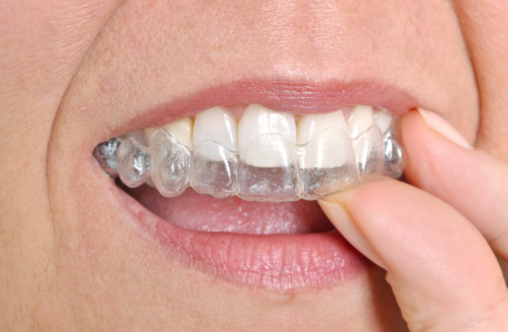 woman attaching her invisalign